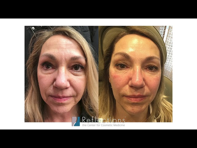 Filler Under the Eyes [Fixing Dark Circles with Filler Injections]
