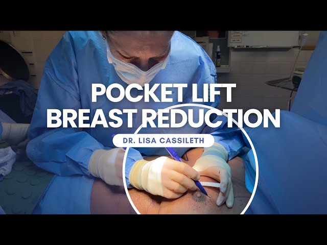 Dr. Lisa Cassileth Performs A Breast Reduction With A Pocket Lift