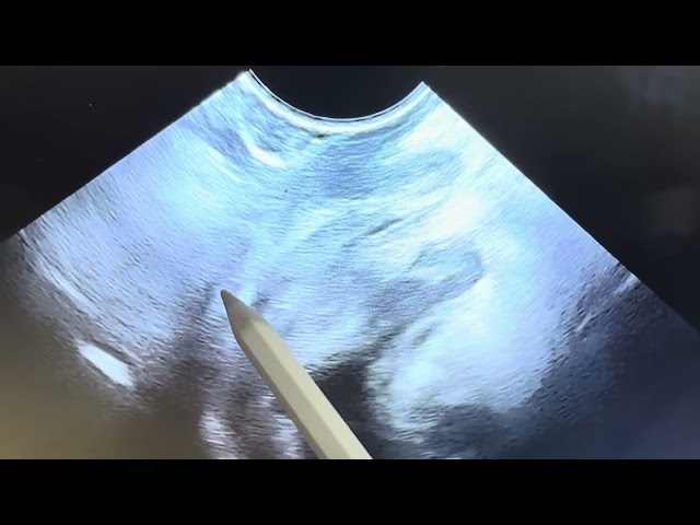 Scanning technique for visualization of terminal part of the rectum by tvs