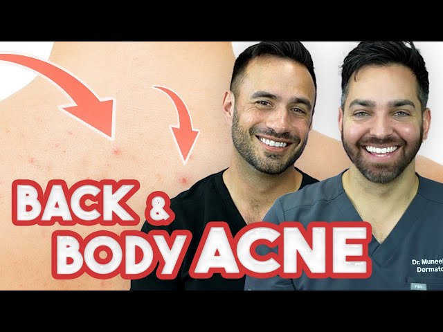 BACK ACNE - How to Treat and Prevent It | Doctorly Routines