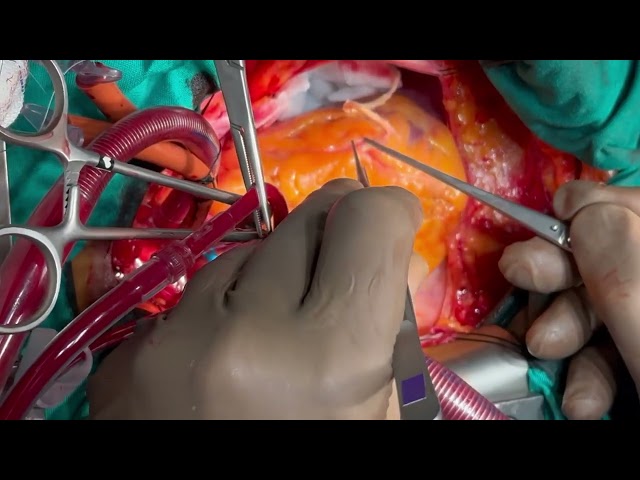 LAD and Right Coronary Artery Closed Endarterectomy in Diffuse Coronary Artery Disease