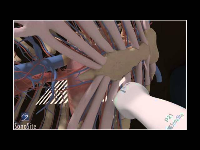 How To: Parasternal Long Axis View, Echocardiography 3D Video