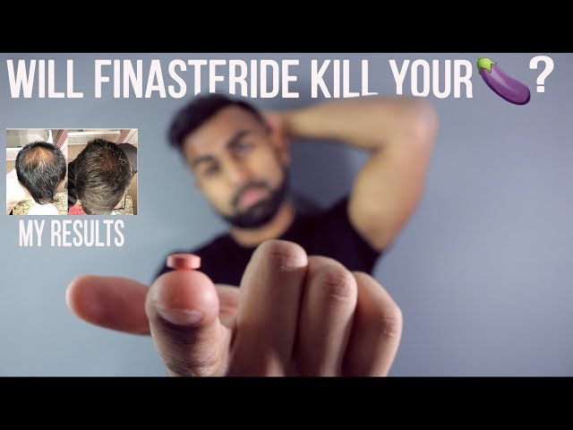 Should You Use Finasteride For Hair Loss? | My Experience and Review 1 Year Later...