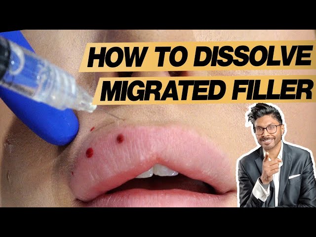 Lip Filler Dissolving Process For Migration (In Real Time)