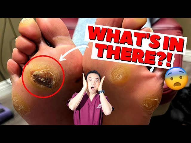 Guess What's Hiding Under This Ulcer?! SURPRISE Inside! 😲 | Ulcer and Callus Removal | Dr. Kim