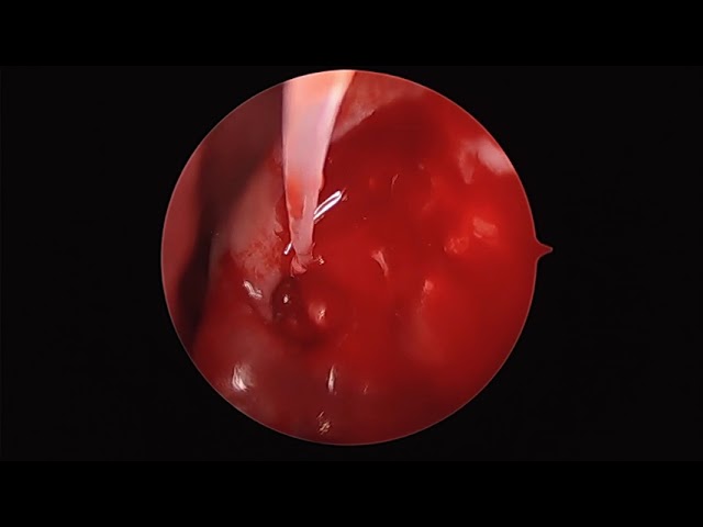 Surgery: Endonasal Dacryocystorhinostomy (DCR)