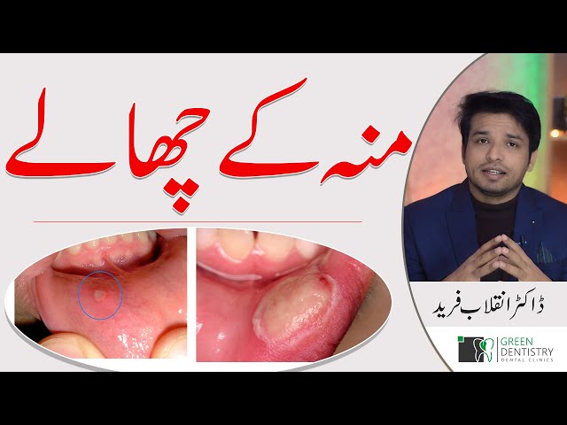 Mouth Ulcers | Oral Ulcers | Causes | Home Treatment | Prevention | Dr. Inqalab F | Urdu | Hindi