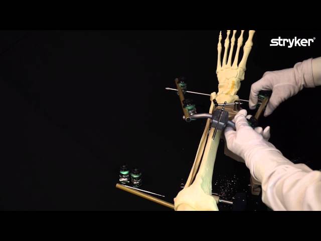 Hoffmann 3 External Fixation System: How to build a Delta Ankle Frame with Hoffmann 3