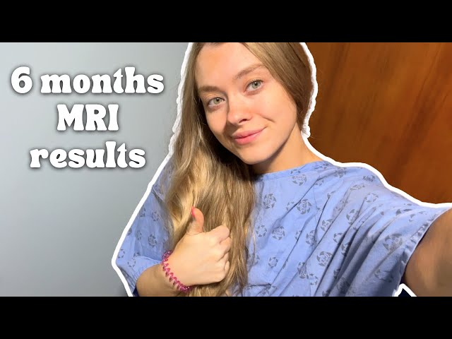 6 Months After Brain Surgery | MRI results + health update