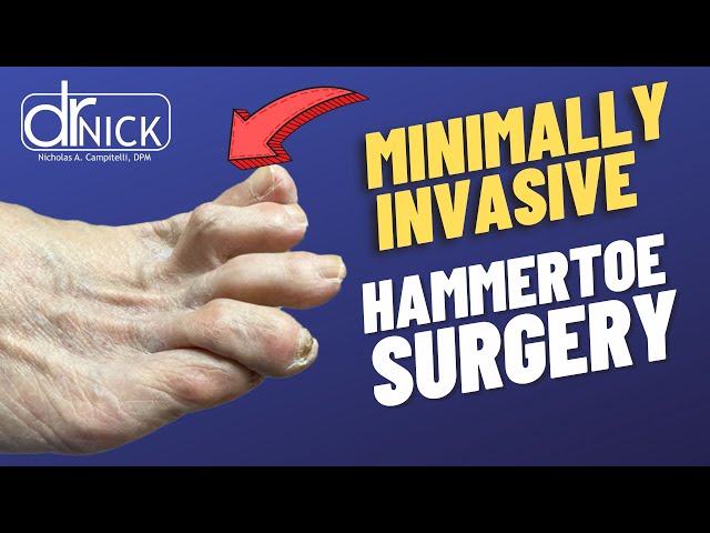 Minimally Invasive Hammer Toe Surgery | Dr. Nick Campitelli