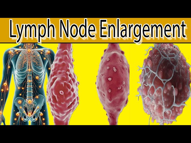 Lymph Node Enlargement  - 7 Most common causes