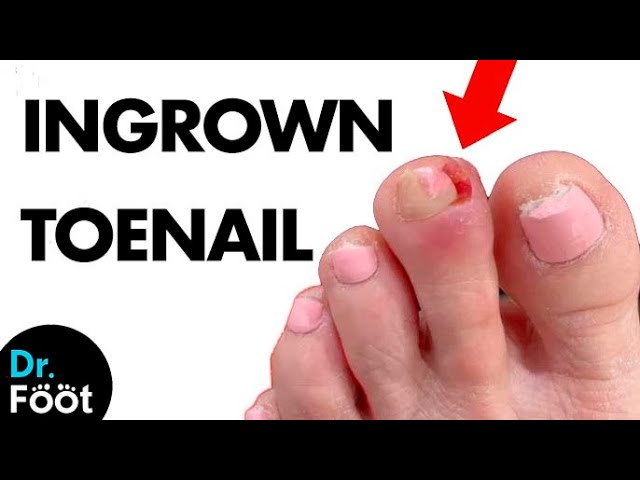 🛠️ Extracting a PAINFUL INGROWN TOENAIL: