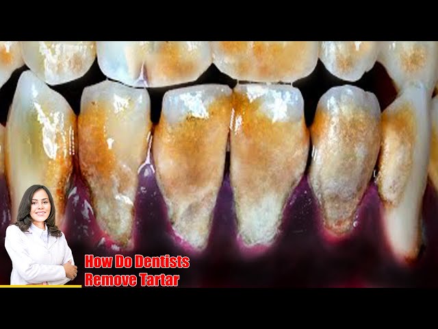 Massive Giant Teeth Tartar Removal Get Rid of Plaque on Teeth! YOU MUST WATCH THIS! large Tartar