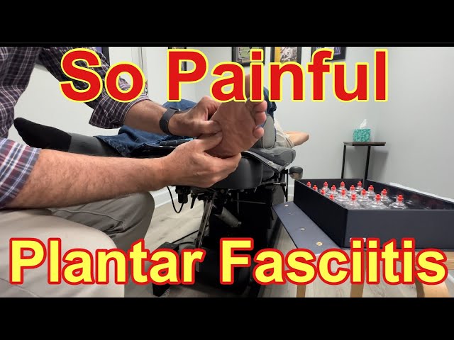 Extremely Successful  Plantar Fasciits Treatment
