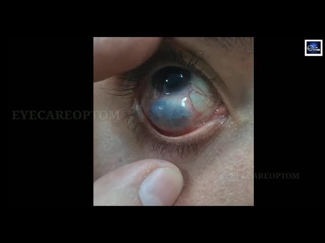 Guess the condition #eyecareoptom #conjunctiva #eye #eyeproblem