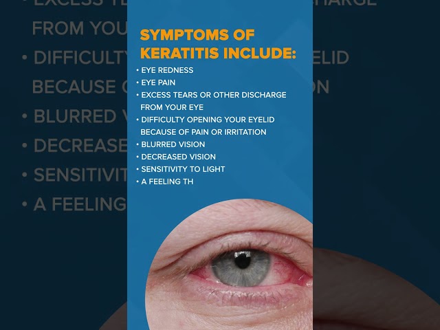 Keratitis is an eye disease | Eye Hospital | Alakh Nayan Mandir | Udaipur