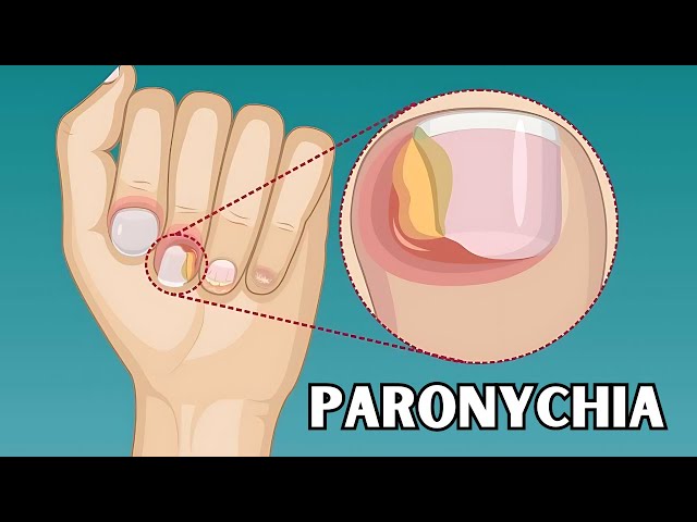 Paronychia - Causes, Risk Factors, Signs & Symptoms, Treatment - Everything You Need To Know