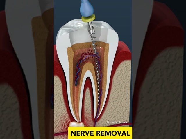 Tooth Cavity & Root Canal