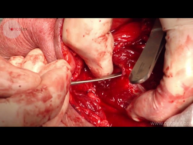 Laryngectomy. Surgical removal of the larynx