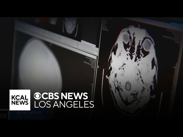 Irvine biotech company gets green light from FDA to continue promising new Alzheimer's treatment