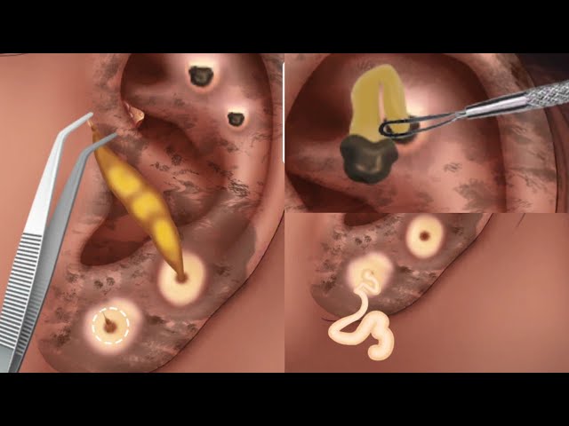 ASMR Remove Animation Ear Piercings Cleaning| Beautyideas Satisfyingvideo