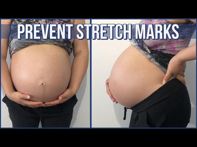 How to prevent stretch marks during pregnancy / how to eliminate stretch marks / natural remedies