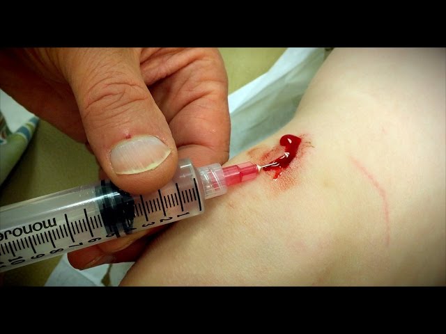 STITCHES: Cleaning, Numbing, & Suturing the Wound | Dr. Paul