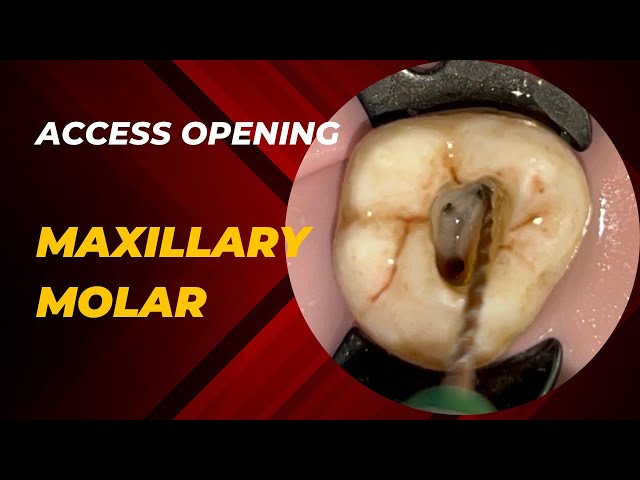 Access Opening of Maxillary Second Molar