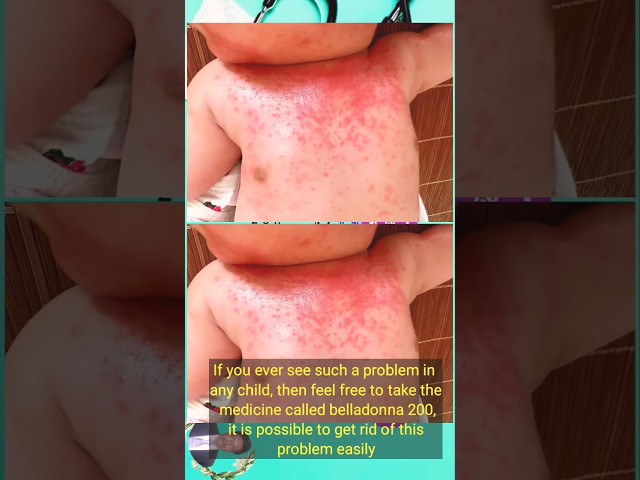 #measles  #skincare #skin problem #redstone #skinspecialist