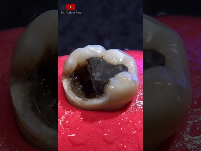 Indirect dental restoration #satisfying