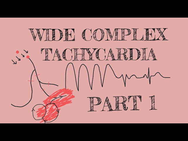 Wide complex tachycardia - Part 1