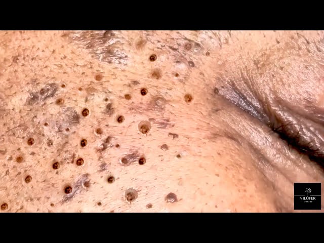 Very Satisfying Extractions | Sebaceous Filaments, Blackheads & Whiteheads | NILUFER ESTHETICS SPA