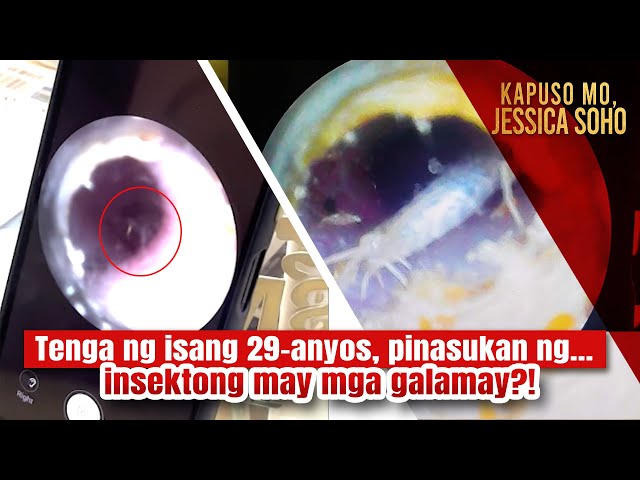Tenga ng isang 29-anyos, pinasukan ng insektong may mga galamay?! | Kapuso Mo, Jessica Soho