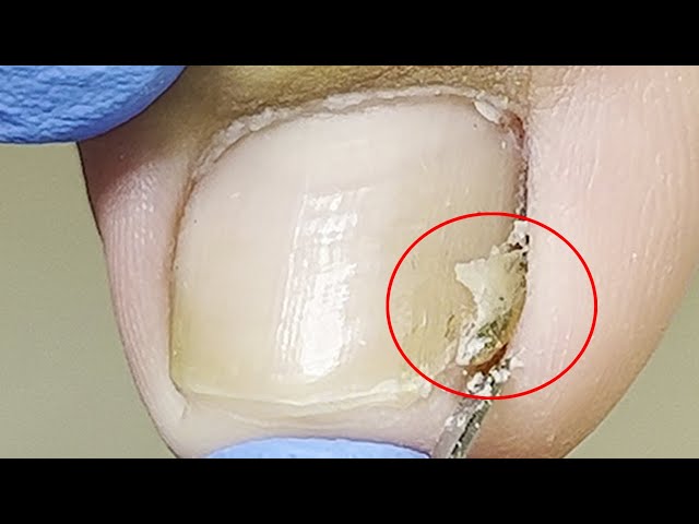 Triangular ingrown nails... let the patient relax for a pedicure【Xue Yidao】