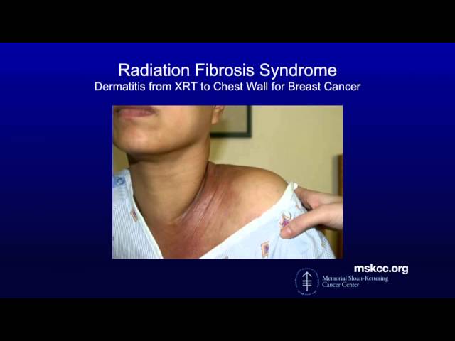 Radiation Fibrosis Syndrome | Memorial Sloan Kettering