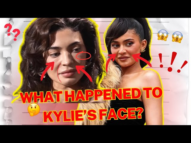 What Happened To Kylie Jenners Face?