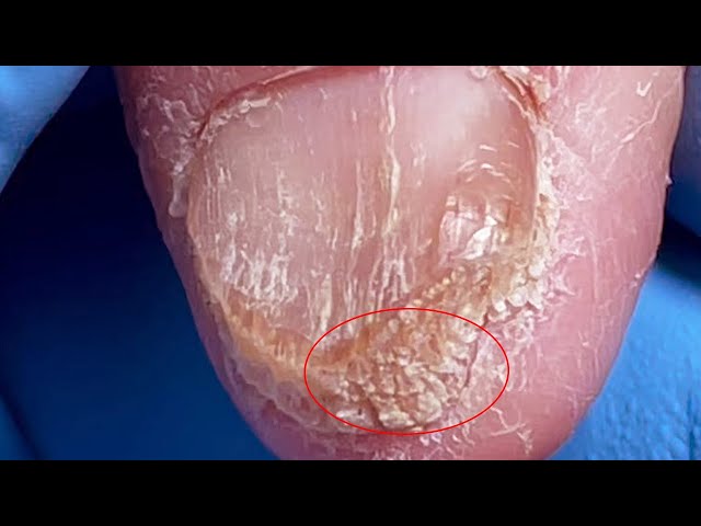 Fungal infection of the hands, thickened nails with blood holes