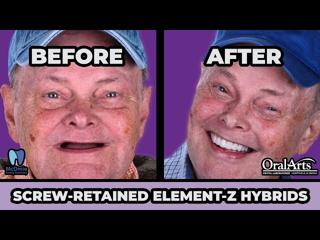 BEFORE & AFTER Element-Z Hybrids 🦷 with Oral Arts & Dr. McOmie! 😁