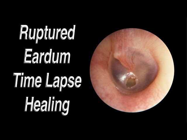 Ruptured Eardrum Healing Closed Time Lapse - A Hole in Eardrum Usually Heals Closed on Its Own!