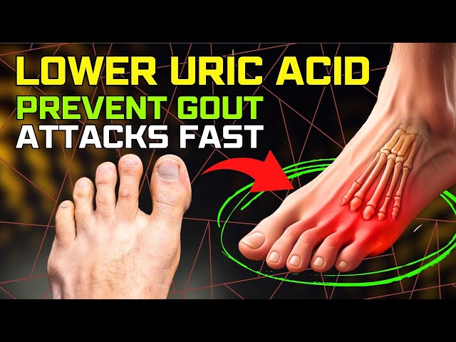 ✅ Top 10 Foods to Lower Uric Acid and Prevent Gout Attacks FAST!