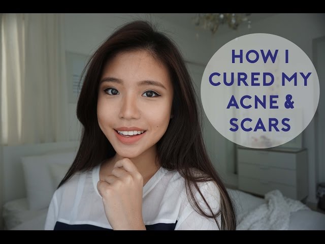 How I Cured My Acne & Acne Scarring | Bhs Indo Subs
