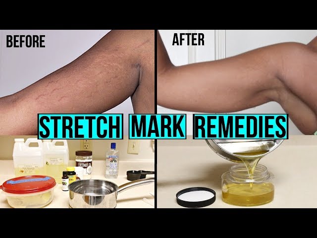 HOW TO GET RID OF STRETCH MARKS & SCARS + DIY AT HOME STRETCH MARK CREAM