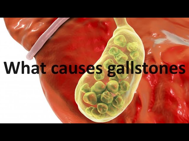 What causes gallstones (...and the thyroid hormone connection)?