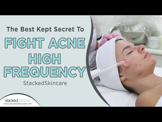 The Best Kept Secret To Fight Acne: High Frequency | StackedSkincare