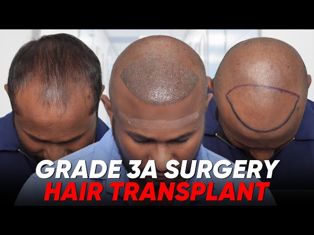 Hair Transplant in Siliguri | Best Results & Cost of Hair Transplant in Siliguri