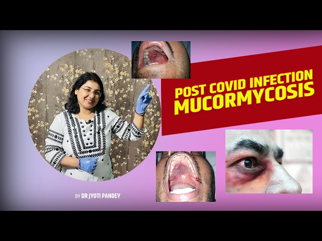 Post covid infection-Mucormycosis