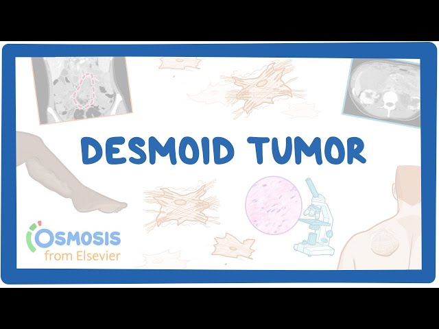 Desmoid Tumor (NORD)