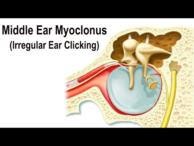Middle Ear Myoclonus - Irregular Clicking Sound in the Ear