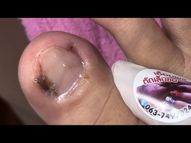 Ep_6484 Ingrown toenail removal 👣 ไม่เจ็บ แต่คันค่ะ 😄 (clip from Thailand)