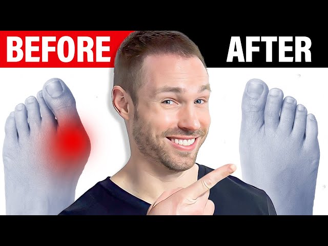 How to Fix Bunions Naturally [No Surgery Needed]